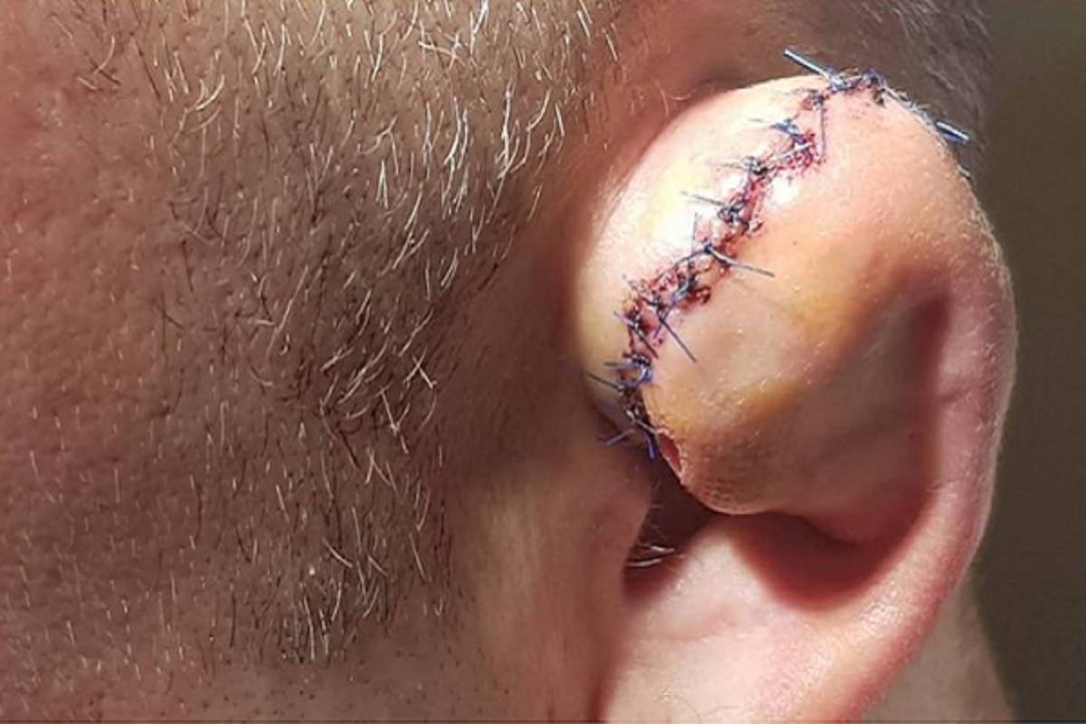 ¡Imagen fuerte! Golpe destroza la oreja de un luchador en evento de MMA en Polonia