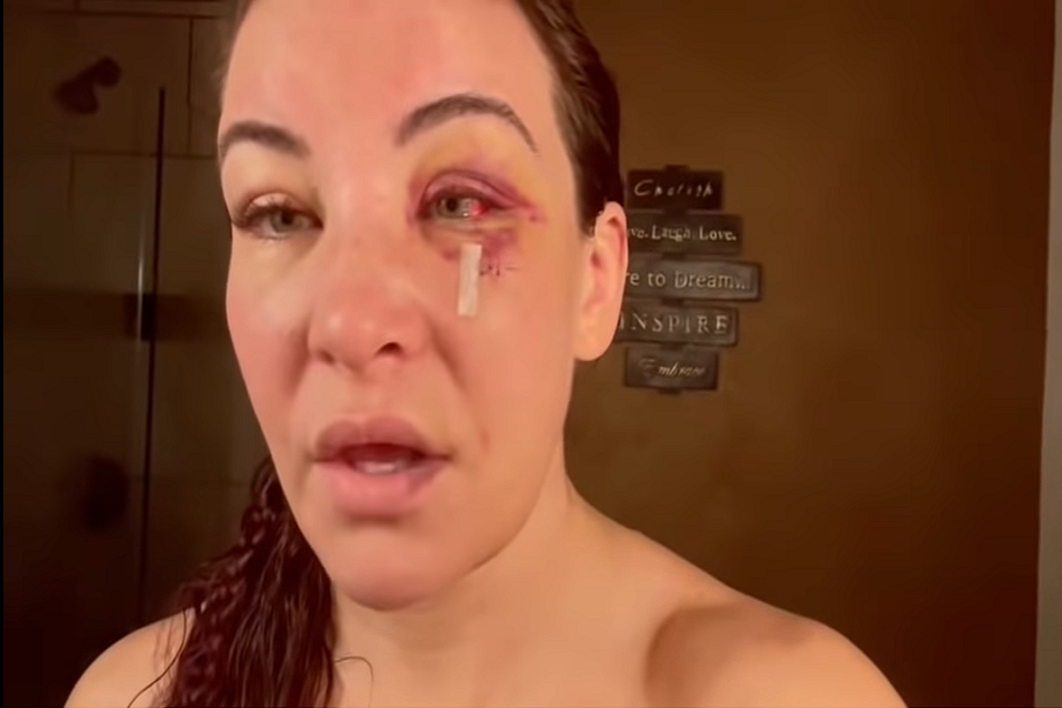 Miesha Tate se quita los puntos de sutura de la cara tras perder ante Ketlen Vieira