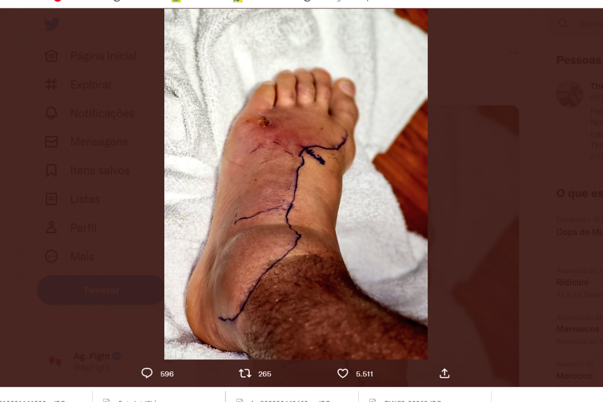 Hospitalizado, Dustin Poirier impresiona al compartir una foto de su pie hinchado